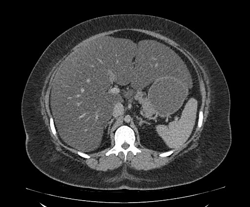Bowel and splenic infarcts in acute lymphocytic leukemia (Radiopaedia 61055-68913 A 45).jpg