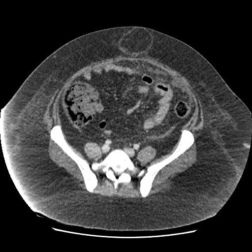 Bowel and splenic infarcts in acute lymphocytic leukemia (Radiopaedia 61055-68915 A 95).jpg