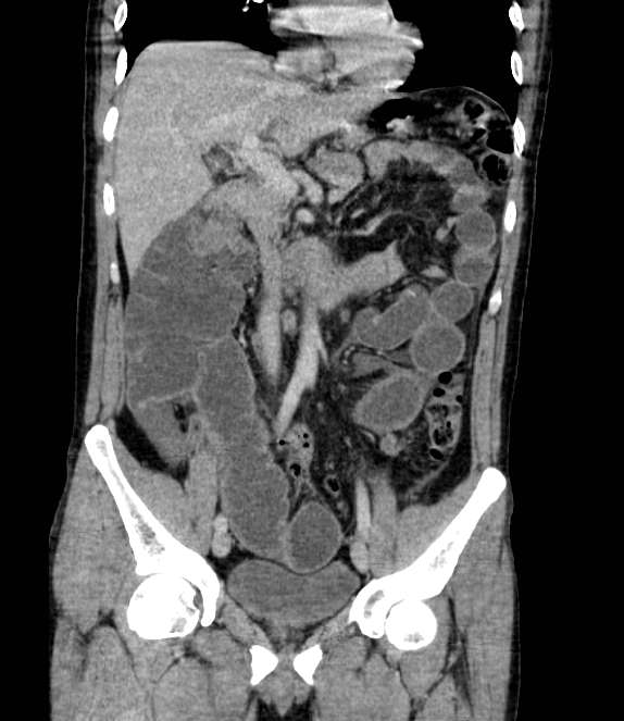 Bowel obstruction from colon carcinoma (Radiopaedia 22995-23028 C 34).jpg