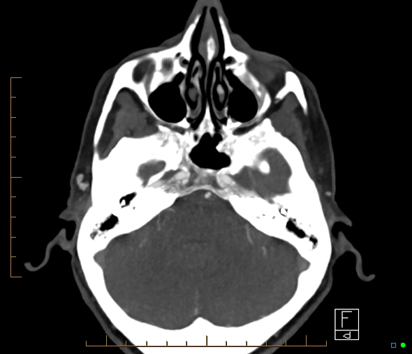 Brachiocephalic trunk stenosis (Radiopaedia 87242-103519 A 52).jpg
