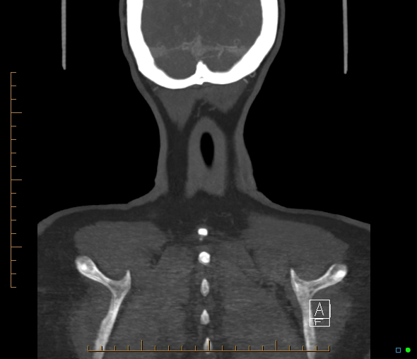 Brachiocephalic trunk stenosis (Radiopaedia 87242-103519 B 71).jpg
