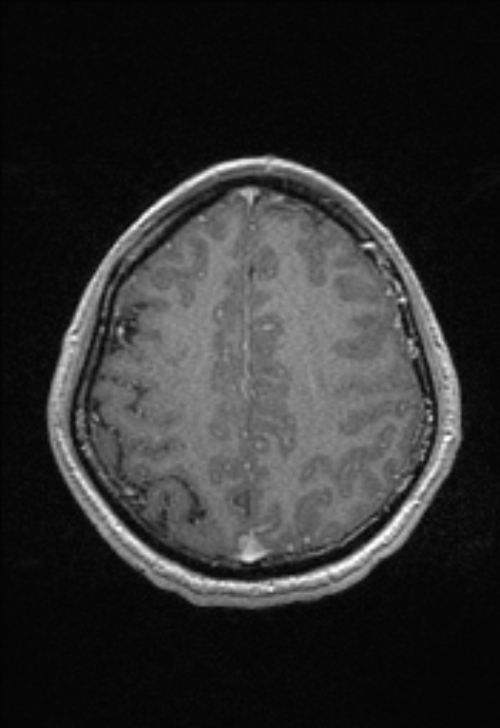 Brain abscess with ventriculitis (Radiopaedia 85703-101495 Axial T1 C+ 133).jpg