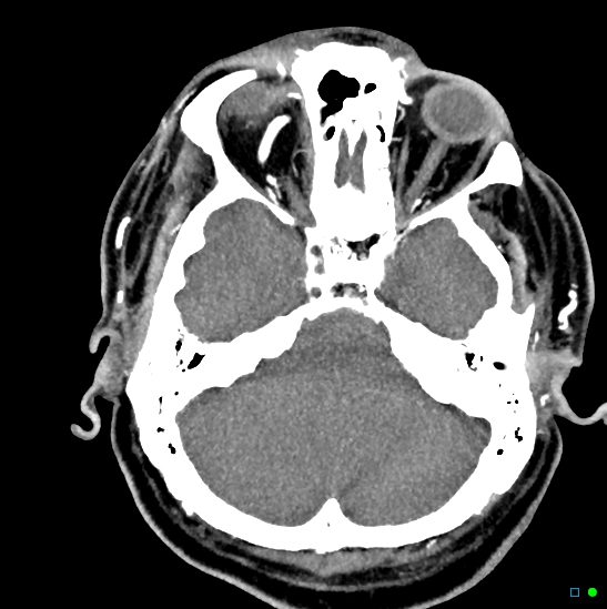 Brain death on MRI and CT angiography (Radiopaedia 42560-45841 B 38).jpg