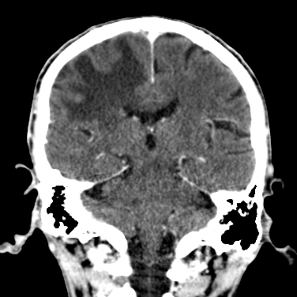Brain metastases from lung cancer (Radiopaedia 27849-28092 Coronal C+ delayed 39).jpg
