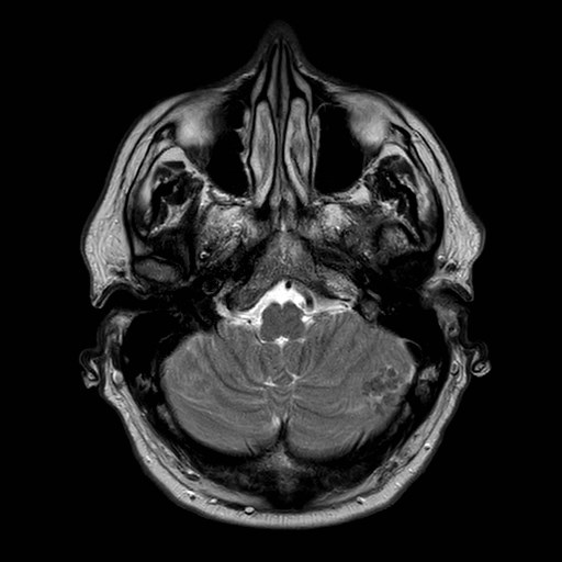 File:Brain metastases from lung cancer (Radiopaedia 83839-99028 Axial T2 7).jpg