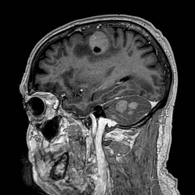 Brain metastases from lung cancer (Radiopaedia 83839-99028 Sagittal T1 C+ 46).jpg