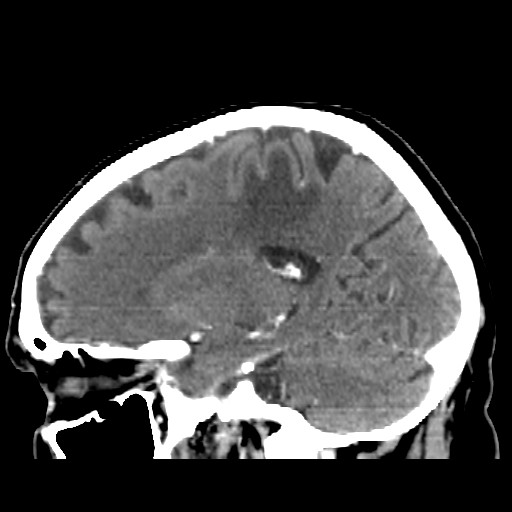 Brain metastasis (Radiopaedia 42617-45760 D 35).jpg