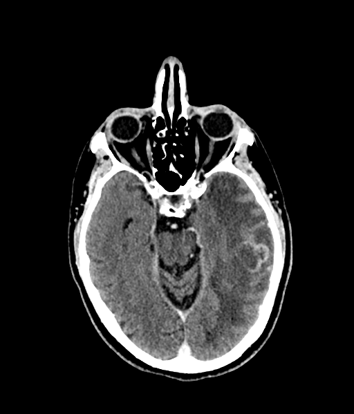 Brain metastasis (large cystic mass) (Radiopaedia 47497-52106 Axial C+ 26).png
