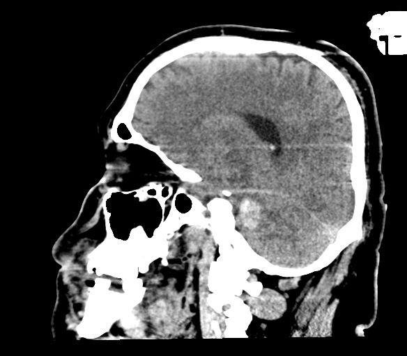 Brainstem hemorrhage (Radiopaedia 81294-94976 C 36).jpg