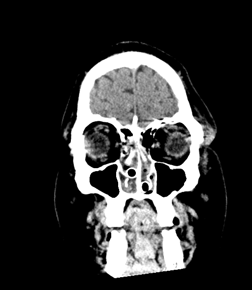 Brainstem hemorrhage (Radiopaedia 81294-94976 Coronal non-contrast 10).jpg
