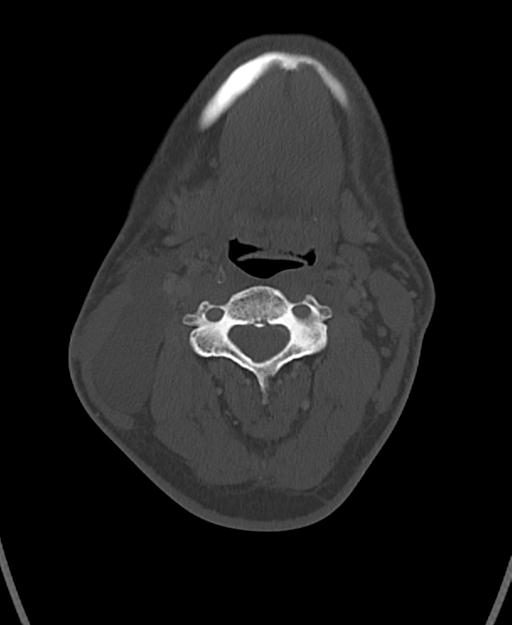 Branchial cleft cyst (Radiopaedia 31167-31875 Axial bone window 33).jpg