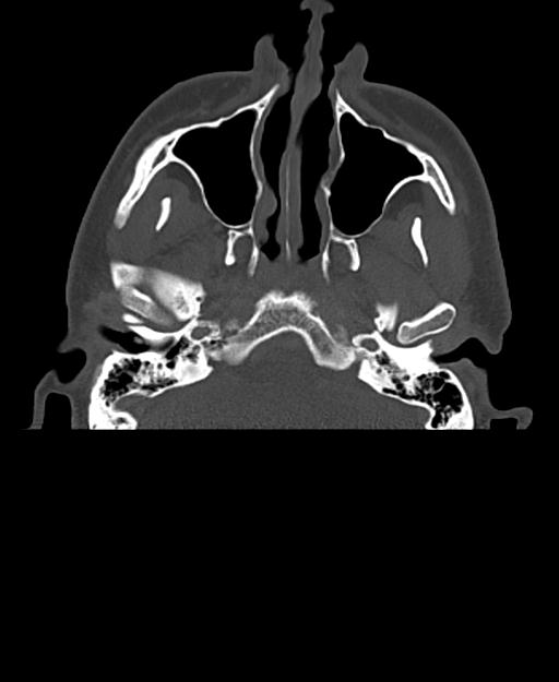 Branchial cleft cyst (Radiopaedia 31167-31875 Axial bone window 8).jpg
