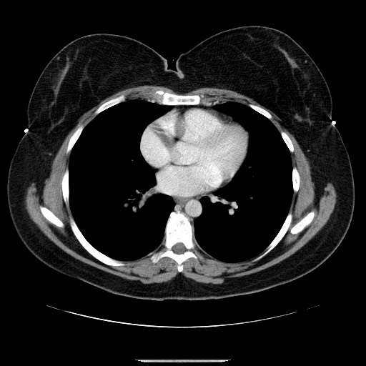 File:Breast cancer pseudocirrhosis after chemotherapy (Radiopaedia 65407-74456 Axial 55).jpg