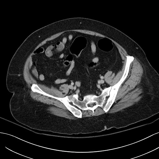 Breast carcinoma with pathological hip fracture (Radiopaedia 60314-67974 B 53).jpg