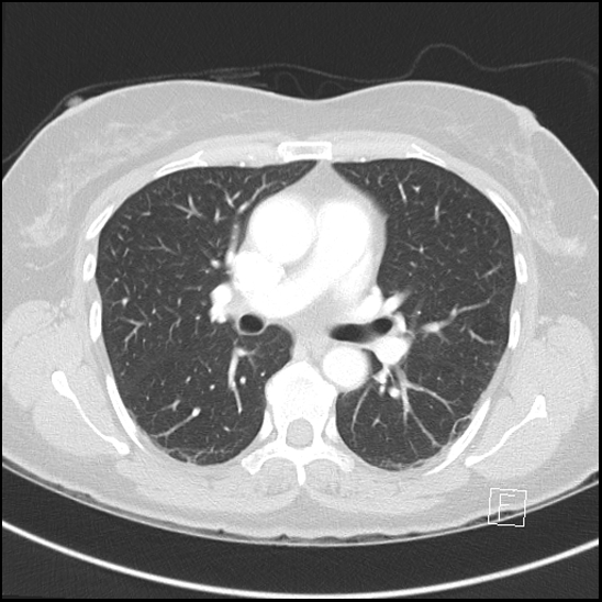 File:Breast metastases from renal cell cancer (Radiopaedia 79220-92225 Axial lung window 38).jpg