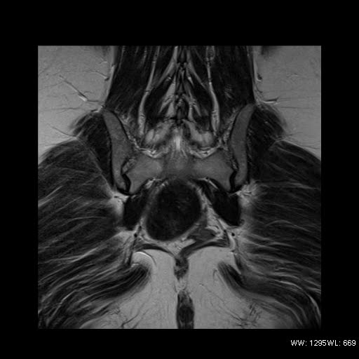 File:Broad ligament fibroid (Radiopaedia 49135-54241 Coronal T2 22).jpg