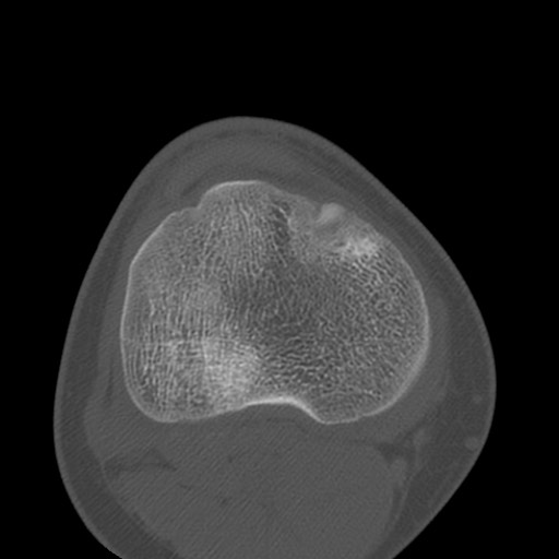 Brodie abscess of the tibia (Radiopaedia 58984-66250 Axial bone window 64).jpg