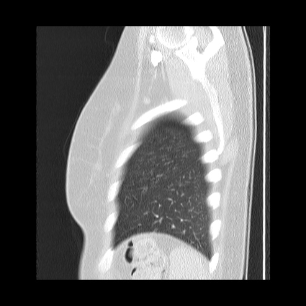 Bronchial atresia (Radiopaedia 22965-22992 Sagittal lung window 7).jpg