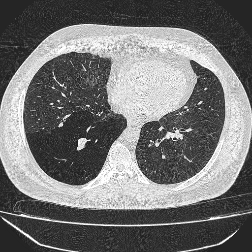 File:Bronchial atresia (Radiopaedia 58271-65417 Axial lung window 32).jpg