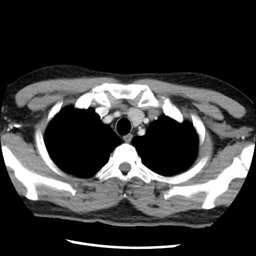 Bronchial carcinoid tumor (Radiopaedia 67377-76764 A 13).jpg