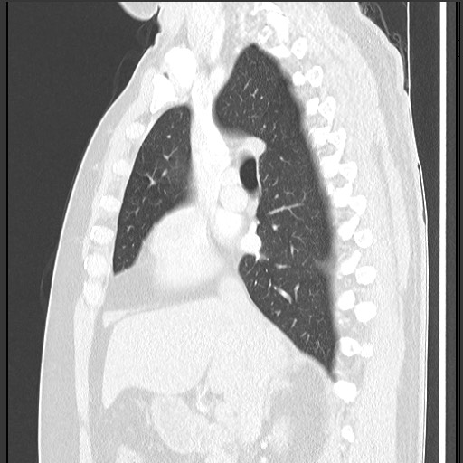 Bronchial carcinoid tumor (Radiopaedia 67377-76764 Sagittal lung window 30).jpg
