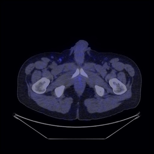 Bronchial carcinoid tumor (Radiopaedia 67377-76765 68Ga-DOTATATE PET-CT 76).jpg