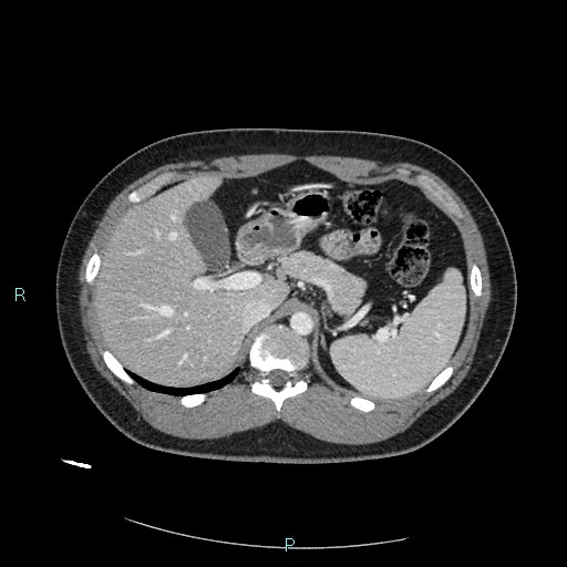 Bronchial carcinoid tumor (Radiopaedia 78272-90875 A 97).jpg