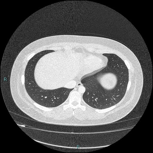 Bronchial carcinoid tumor (Radiopaedia 78272-90875 Axial lung window 41).jpg