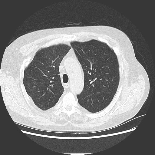 Bronchial stenosis - lung transplant (Radiopaedia 73133-83848 Axial lung window 21).jpg
