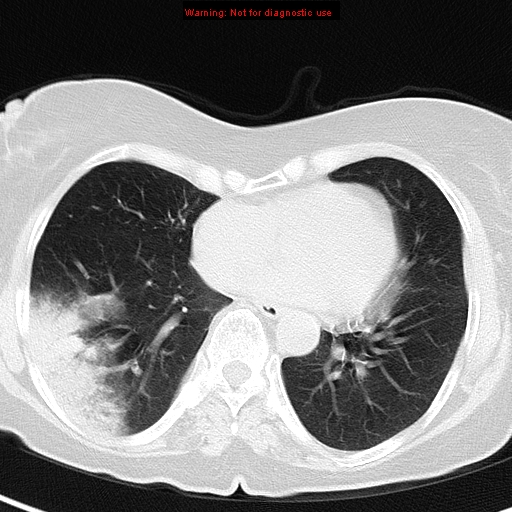 File:Bronchoalveolar carcinoma (BAC) (Radiopaedia 13436-13392 Axial lung window 33).jpg