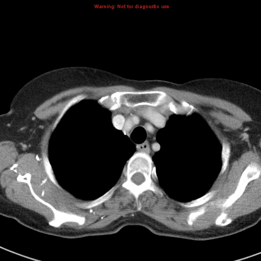 File:Bronchoalveolar carcinoma (BAC) (Radiopaedia 13436-13392 B 10).jpg