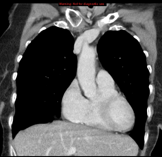 Bronchoalveolar carcinoma (BAC) (Radiopaedia 13436-13392 E 18).jpg