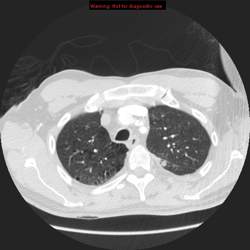 File:Bronchogenic carcinoma brain metastasis (Radiopaedia 9286-105832 Axial lung window 27).jpg