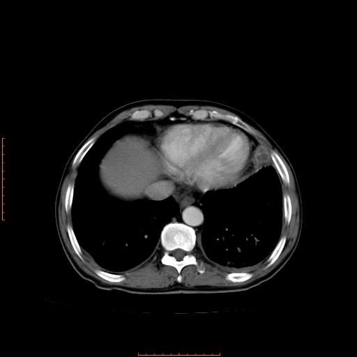 File:Bronchogenic carcinoma with left atrial large deposit - T4N3M1a (Radiopaedia 42316-45428 A 23).jpg