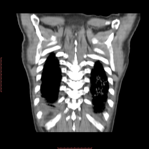 File:Bronchogenic carcinoma with left atrial large deposit - T4N3M1a (Radiopaedia 42316-45428 B 16).jpg