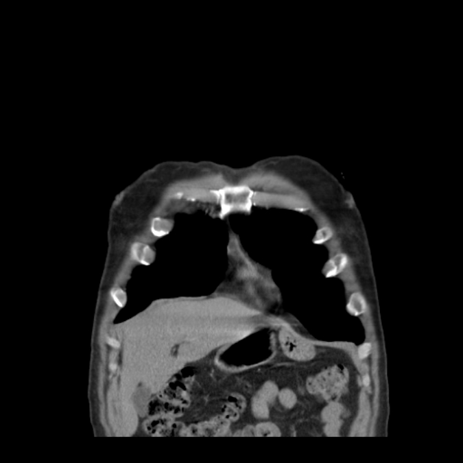 Bronchogenic carcinoma with upper lobe collapse (Radiopaedia 29297-29726 D 11).jpg