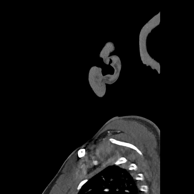 Buccal fat pad arteriovenous malformation (Radiopaedia 70936-81144 C 19).jpg