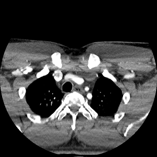 Buccal fat pad arteriovenous malformation (Radiopaedia 70936-81144 D 16).jpg