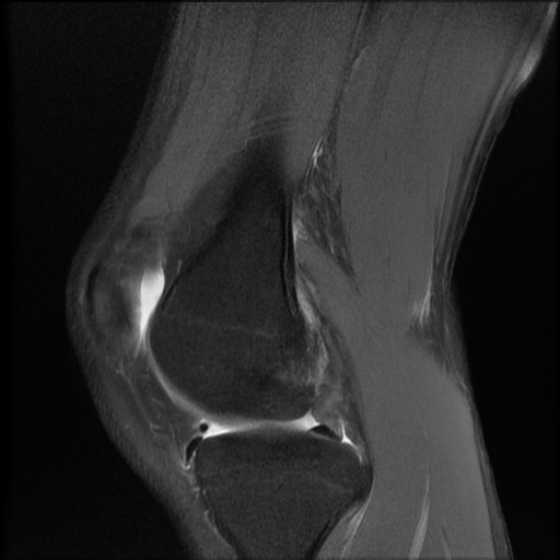 File:Bucket-handle meniscus tear (Radiopaedia 65700-74809 Sagittal PD fat sat 9).jpg