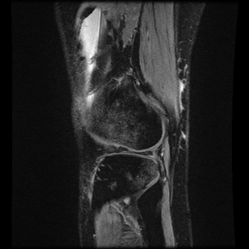 Bucket handle meniscus tear (Radiopaedia 56916-63751 H 12).jpg