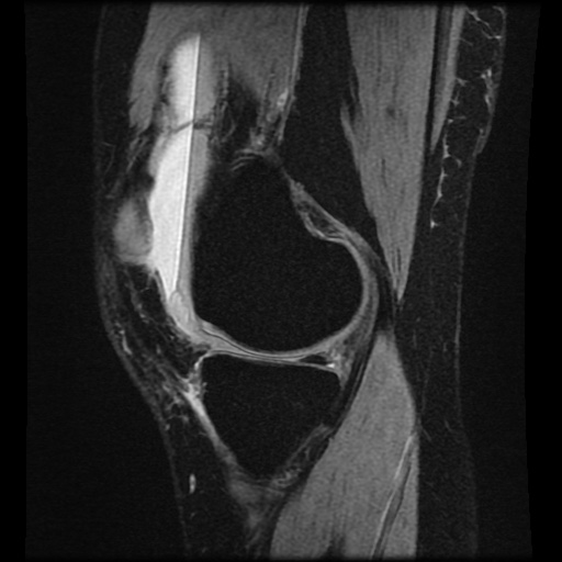 File:Bucket handle meniscus tear (Radiopaedia 56916-63751 H 58).jpg