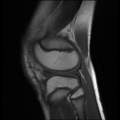File:Bucket handle tear - lateral meniscus (Radiopaedia 72124-82634 Sagittal T1 3).jpg