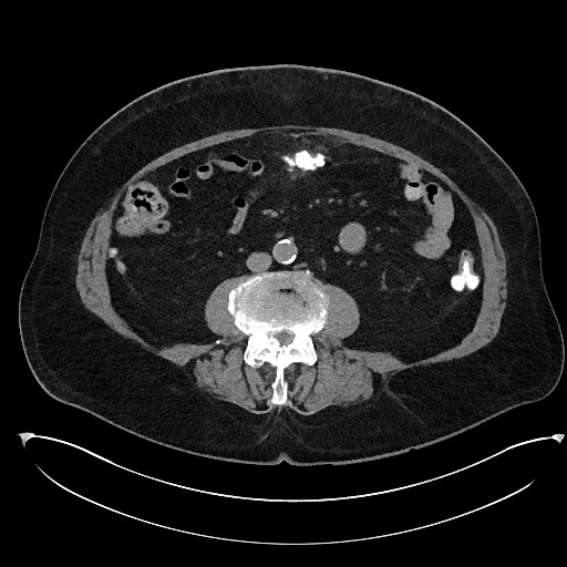 File:Buried bumper syndrome - gastrostomy tube (Radiopaedia 63843-72577 Axial Inject 64).jpg