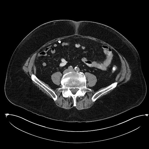 File:Buried bumper syndrome - gastrostomy tube (Radiopaedia 63843-72577 Axial Inject 78).jpg