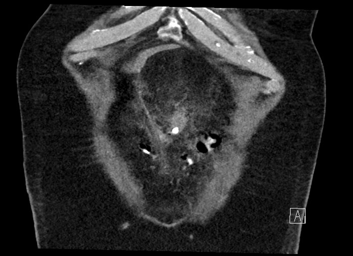 Buried bumper syndrome - gastrostomy tube (Radiopaedia 63843-72577 Coronal Inject 22).jpg