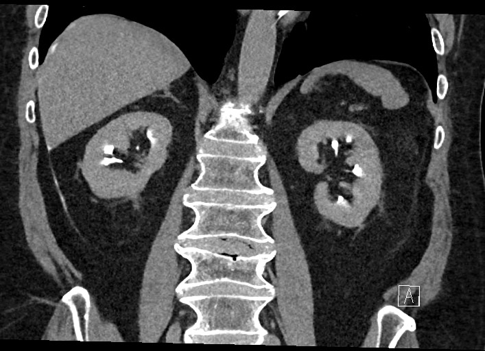 Buried bumper syndrome - gastrostomy tube (Radiopaedia 63843-72577 Coronal Inject 88).jpg