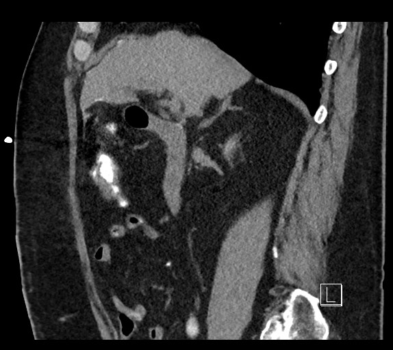 Buried bumper syndrome - gastrostomy tube (Radiopaedia 63843-72577 Sagittal Inject 77).jpg