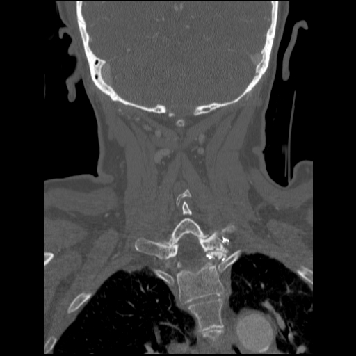 File:C1 anterior arch (plough) fracture - type 1 (Radiopaedia 76181-87720 Coronal bone window 28).jpg