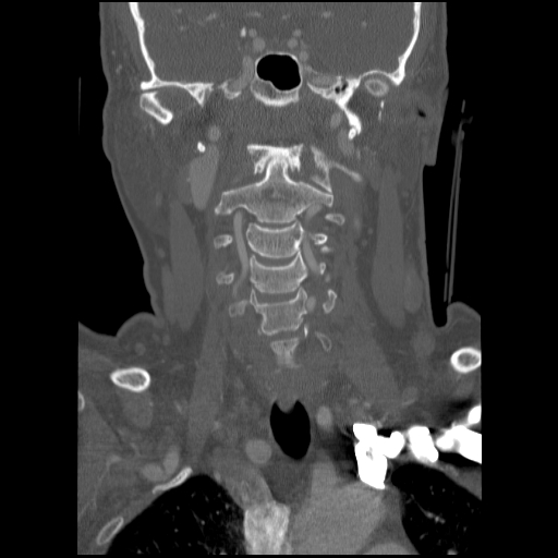 C1 anterior arch (plough) fracture - type 1 (Radiopaedia 76181-87720 Coronal bone window 59).jpg
