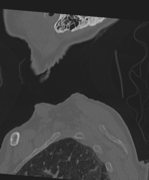 C2 fracture with vertebral artery dissection (Radiopaedia 37378-39199 Sagittal bone window 4).png